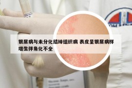銀屑病與未分化結(jié)締組織病 表皮呈銀屑病樣增生伴角化不全