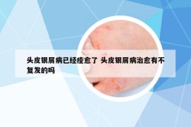 頭皮銀屑病已經(jīng)痊愈了 頭皮銀屑病治愈有不復發(fā)的嗎