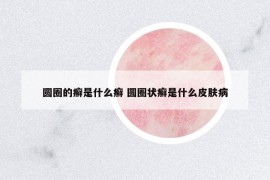 圓圈的癬是什么癬 圓圈狀癬是什么皮膚病