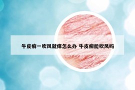 牛皮癬一吹風就癢怎么辦 牛皮癬能吹風嗎
