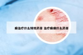 癬治療什么特效藥膏 治療癬病什么藥膏