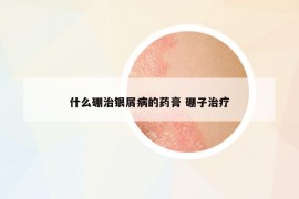 什么硼治銀屑病的藥膏 硼子治療