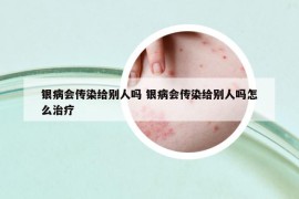 銀病會(huì)傳染給別人嗎 銀病會(huì)傳染給別人嗎怎么治療