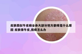 皮膚類似牛皮癬全身大部分地方都癢是什么原因 皮膚像牛皮,很癢怎么辦
