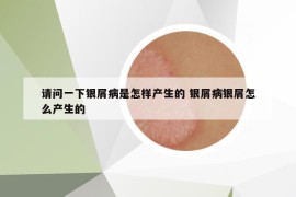 請問一下銀屑病是怎樣產(chǎn)生的 銀屑病銀屑怎么產(chǎn)生的