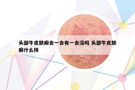 頭部牛皮膚癬會(huì)一會(huì)有一會(huì)沒嗎 頭部牛皮膚癬什么樣
