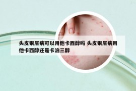 頭皮銀屑病可以用他卡西醇嗎 頭皮銀屑病用他卡西醇還是卡泊三醇