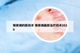 銀屑病的新技術(shù) 銀屑病最新治療技術(shù)2020