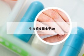牛皮癬皮損小于10