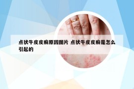 點狀牛皮皮癬原因圖片 點狀牛皮皮癬是怎么引起的
