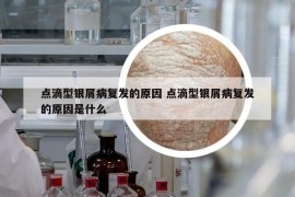 點(diǎn)滴型銀屑病復(fù)發(fā)的原因 點(diǎn)滴型銀屑病復(fù)發(fā)的原因是什么