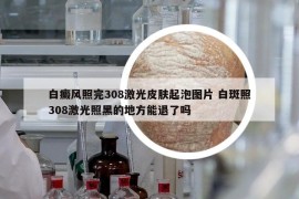 白癜風(fēng)照完308激光皮膚起泡圖片 白斑照308激光照黑的地方能退了嗎