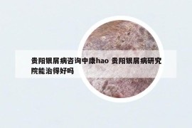 貴陽銀屑病咨詢中康hao 貴陽銀屑病研究院能治得好嗎