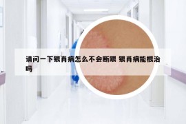 請問一下銀肖病怎么不會斷跟 銀肖病能根治嗎