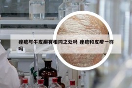 痤瘡與牛皮癬有相同之處嗎 痤瘡和皮疹一樣嗎
