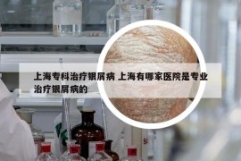 上海?？浦委熴y屑病 上海有哪家醫(yī)院是專業(yè)治療銀屑病的