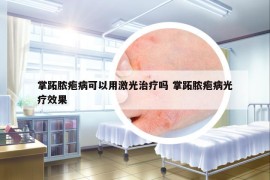 掌跖膿皰病可以用激光治療嗎 掌跖膿皰病光療效果