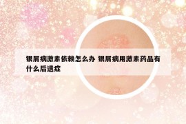 銀屑病激素依賴怎么辦 銀屑病用激素藥品有什么后遺癥
