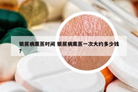 銀屑病熏蒸時(shí)間 銀屑病熏蒸一次大約多少錢?