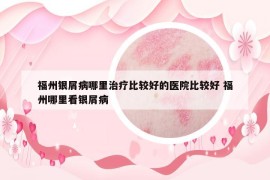 福州銀屑病哪里治療比較好的醫(yī)院比較好 福州哪里看銀屑病