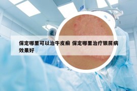 保定哪里可以治牛皮癬 保定哪里治療銀屑病效果好
