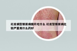 紅皮病型銀屑病圖片吃什么 紅皮型銀屑病比較嚴(yán)重用什么藥好