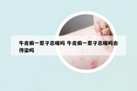 牛皮癬一輩子忌嘴嗎 牛皮癬一輩子忌嘴嗎會傳染嗎
