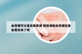 血常規(guī)可以查出銀屑病 銀屑病做血常規(guī)檢查能看出來了吧