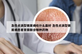 急性點(diǎn)滴型銀屑病吃什么最好 急性點(diǎn)滴型銀屑病患者常需聯(lián)合哪種藥物