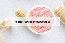 手癬是什么癥狀 拍照識別皮膚病
