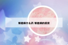 銀翹癬什么藥 銀翹病的癥狀