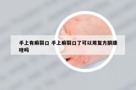 手上有癬裂口 手上癬裂口了可以用復(fù)方酮康唑嗎