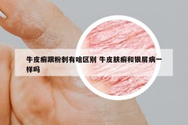 牛皮癬跟粉刺有啥區(qū)別 牛皮膚癬和銀屑病一樣嗎