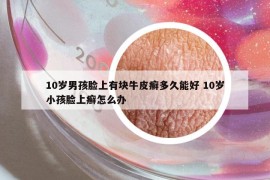 10歲男孩臉上有塊牛皮癬多久能好 10歲小孩臉上癬怎么辦