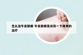 怎么治牛皮膚癬 牛皮膚癬告訴你一個簡單的治療