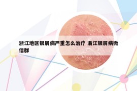 浙江地區(qū)銀屑病嚴(yán)重怎么治療 浙江銀屑病微信群