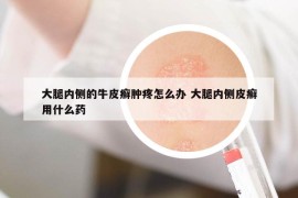 大腿內(nèi)側(cè)的牛皮癬腫疼怎么辦 大腿內(nèi)側(cè)皮癬用什么藥