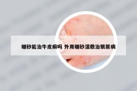 硼砂能治牛皮癬嗎 外用硼砂濕敷治銀屑病