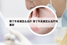 得了牛皮病怎么治療 得了牛皮病怎么治療效果好