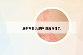 皮癬用什么涂抹 皮蘚涂什么