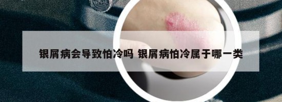 銀屑病會(huì)導(dǎo)致怕冷嗎 銀屑病怕冷屬于哪一類(lèi)