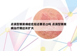 點滴型銀屑病痊愈后還要忌口嗎 點滴型銀屑病治療期還長擴大