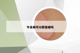 牛皮癬可以敷蜜蠟嗎