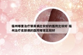 福州哪里治療銀屑病比較好的醫(yī)院比較好 福州治療皮膚病的醫(yī)院哪家比較好