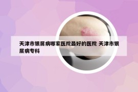 天津市銀屑病哪家醫(yī)院最好的醫(yī)院 天津市銀屑病?？? /></a>		
		</figure>

		<header class=