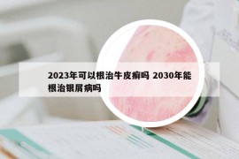 2023年可以根治牛皮癬嗎 2030年能根治銀屑病嗎