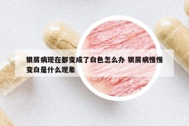 銀屑病現在都變成了白色怎么辦 銀屑病慢慢變白是什么現象