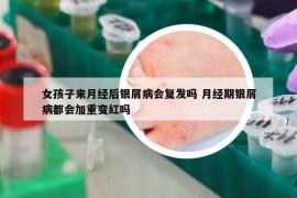 女孩子來月經(jīng)后銀屑病會(huì)復(fù)發(fā)嗎 月經(jīng)期銀屑病都會(huì)加重變紅嗎