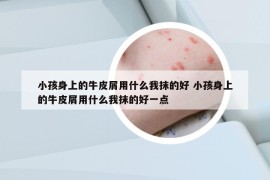 小孩身上的牛皮屑用什么我抹的好 小孩身上的牛皮屑用什么我抹的好一點