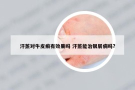 汗蒸對(duì)牛皮癬有效果嗎 汗蒸能治銀屑病嗎?